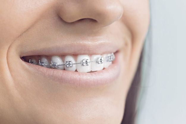 Braces & Aligners